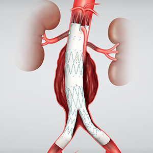 Fenestrated Stent Grafts Expand Options for Endovascular Repair of AAA ...